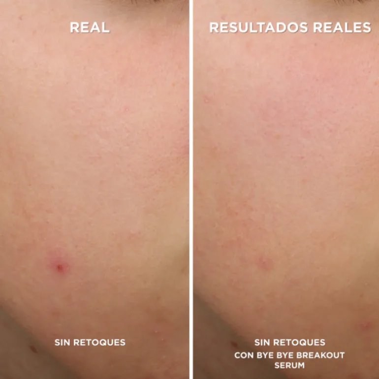 BYE BYE BREAKOUT SERUM