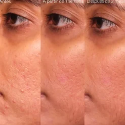 Vinopure Sérum con Acido Salicílico Anti-imperfecciones